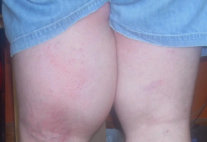 Liposarcoma