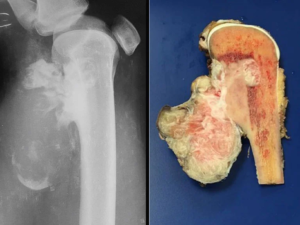 Osteosarcoma