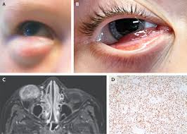 Rhabdomyosarcoma