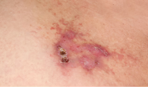 angiosarcoma